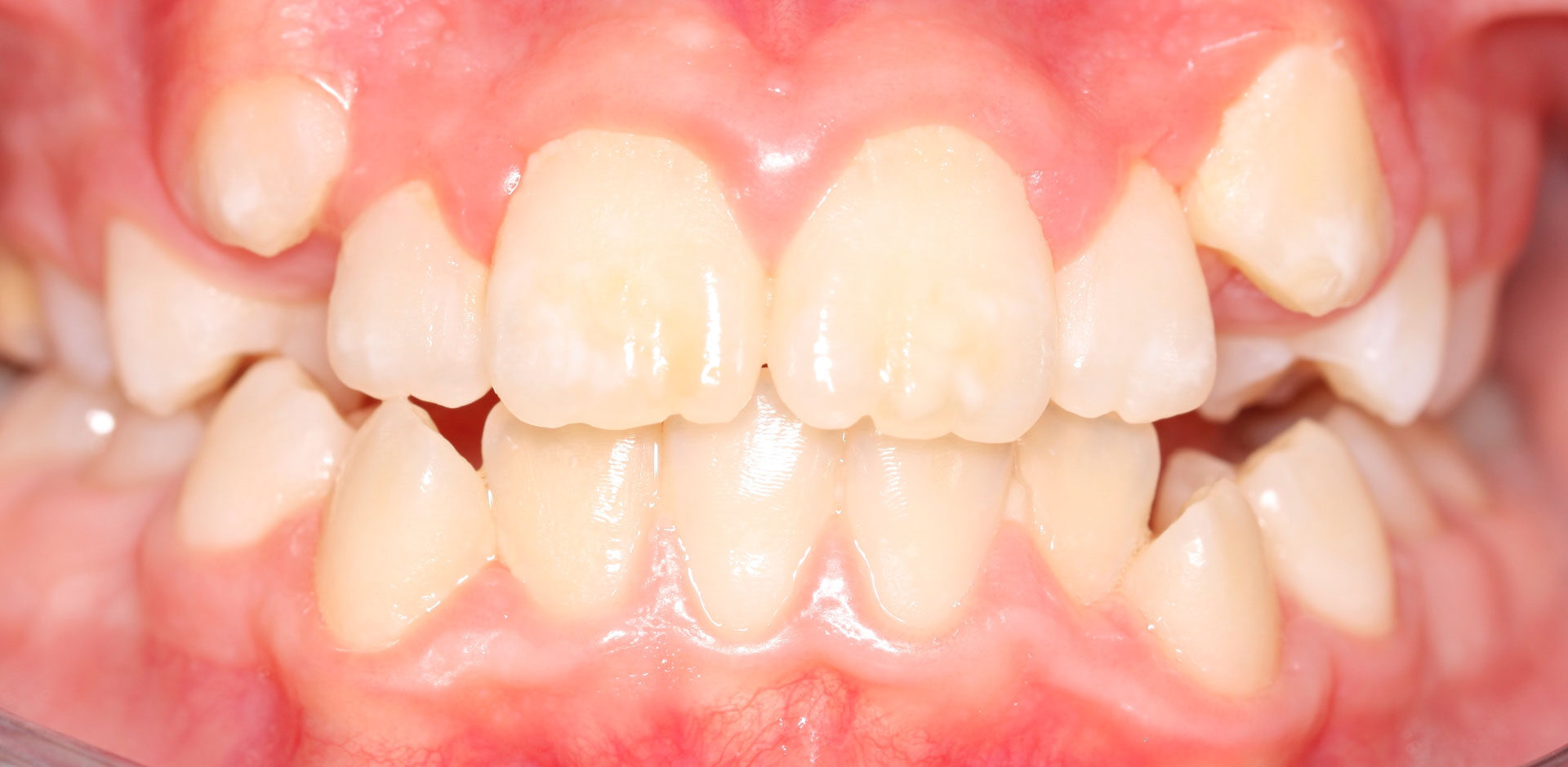 Dentadura previa tratamiento ortodoncia