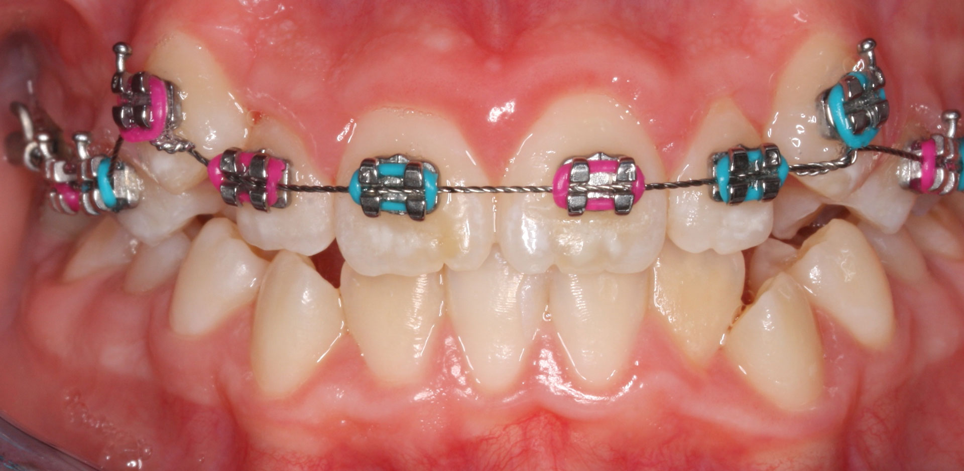 Ortodoncia en proceso