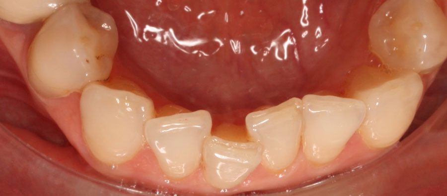 Caso para ortodoncia fija