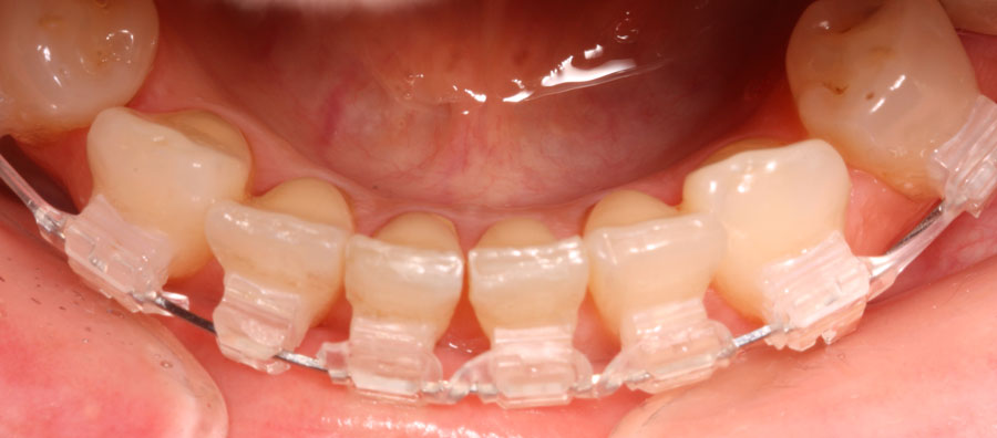 Ortodoncia fija resultado