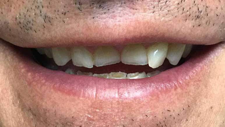 Dentadura previa tratamiento dental